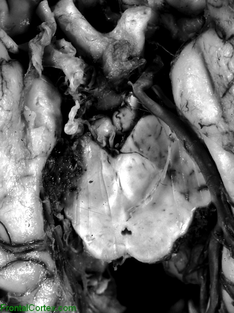 Cavernous angioma, ventral surface of brain, close-up